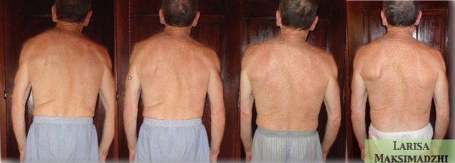 Сurvatura de la columna vertebral. Tratamiento con bioenergética.