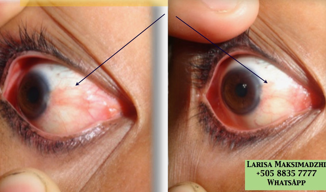 болезни глаз. лечение биоенергетикой