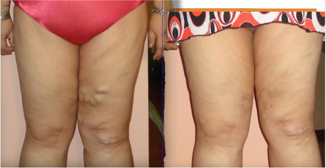 Varicose veins. Bioenergetic Center Nicaragua