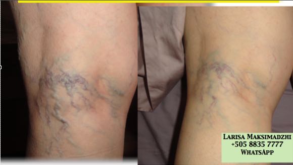 Varicose veins. Bioenergetic Center Nicaragua