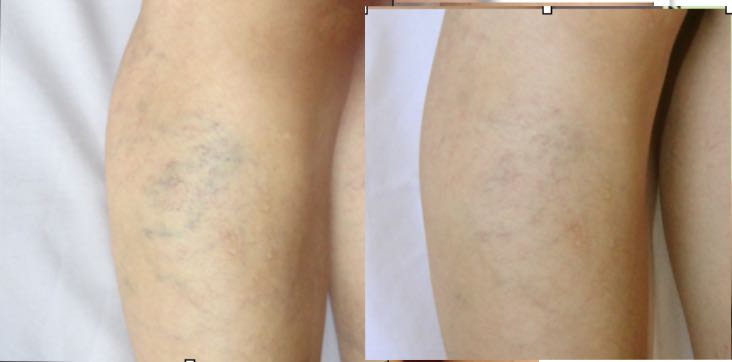 Varicose veins. Bioenergetic Center Nicaragua