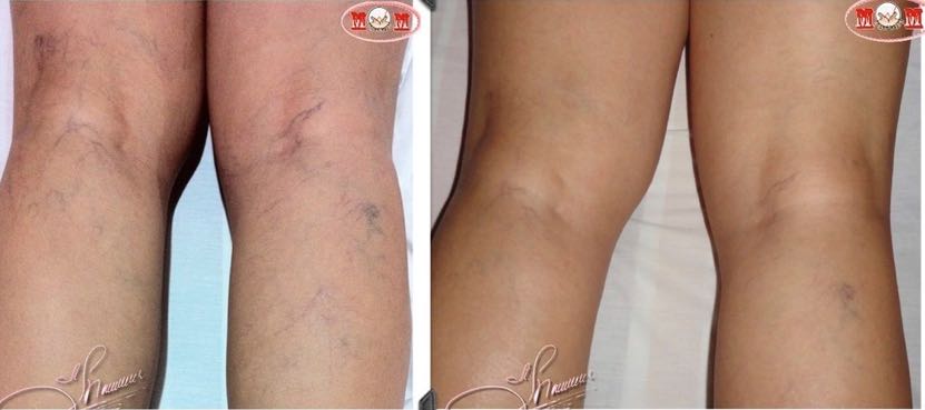 Varicose veins. Bioenergetic Center Nicaragua