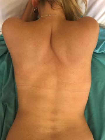 curacion bioenergetica en Nicaragua. Hernia intervertebral